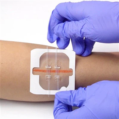 Penutupan Penutupan Kulit Perubatan Penutupan Luka